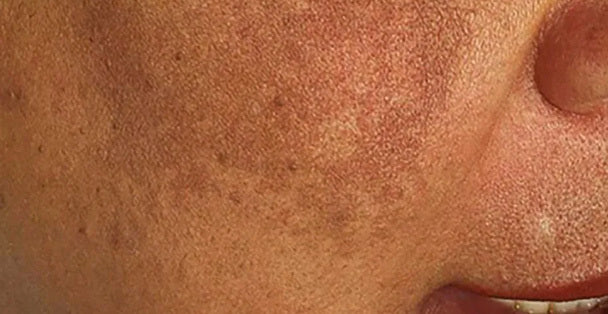 Skin Hyperpigmentation: Causes, Types, Treatments and What You Need To Know!