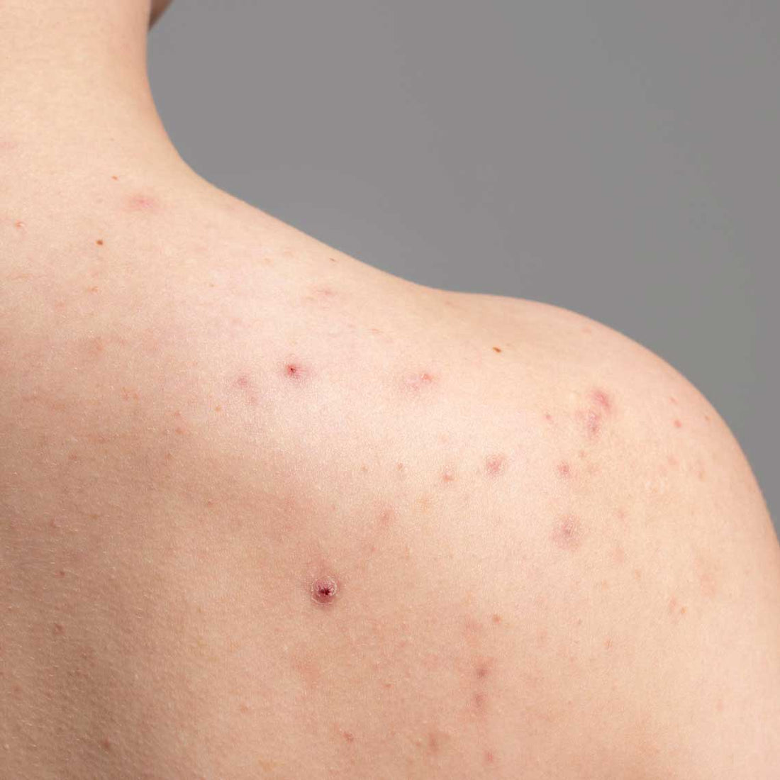 What Is Bacne and How to Get Rid of It?