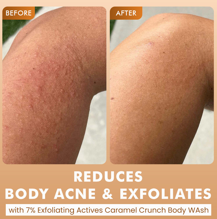 Brighten, De-Tan & Acne-Free Body Wash Combo