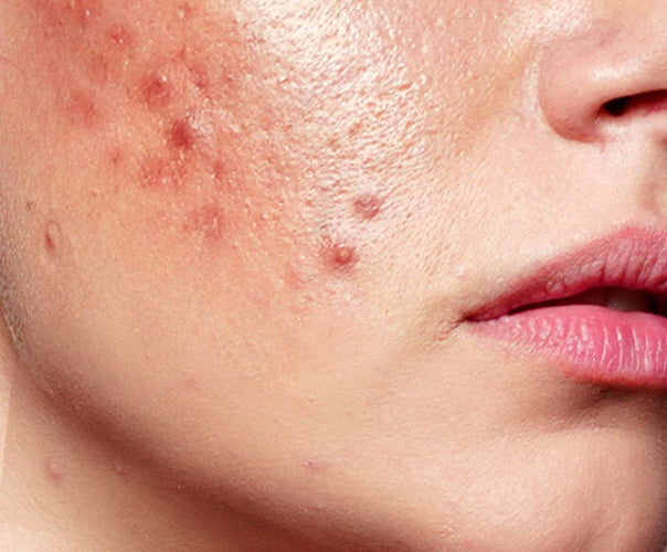Shop By Concerns - Acne control