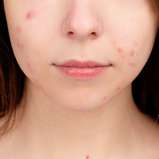 5 ways to get rid of acne scars fast