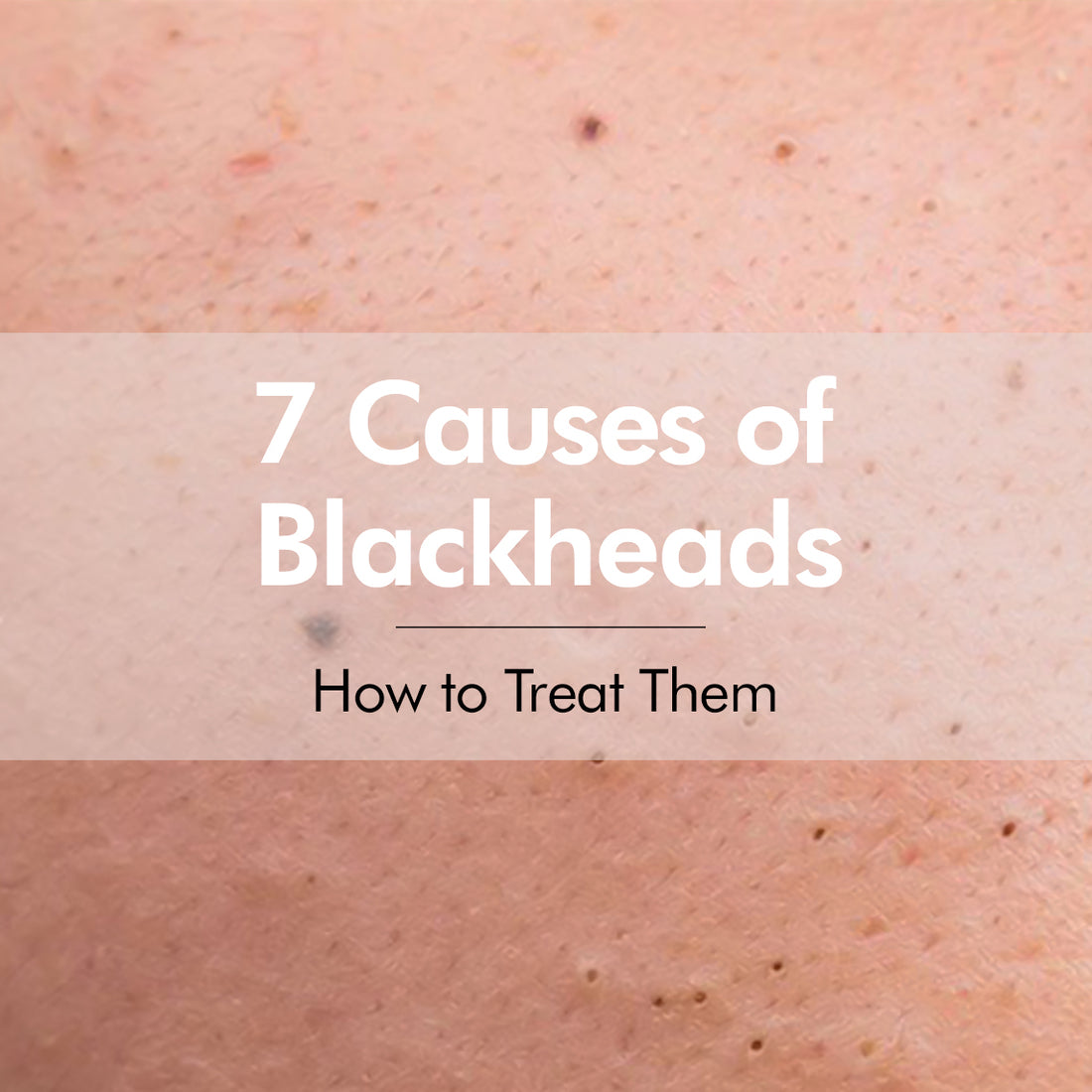 7 Causes of Blackheads & How to Treat Them