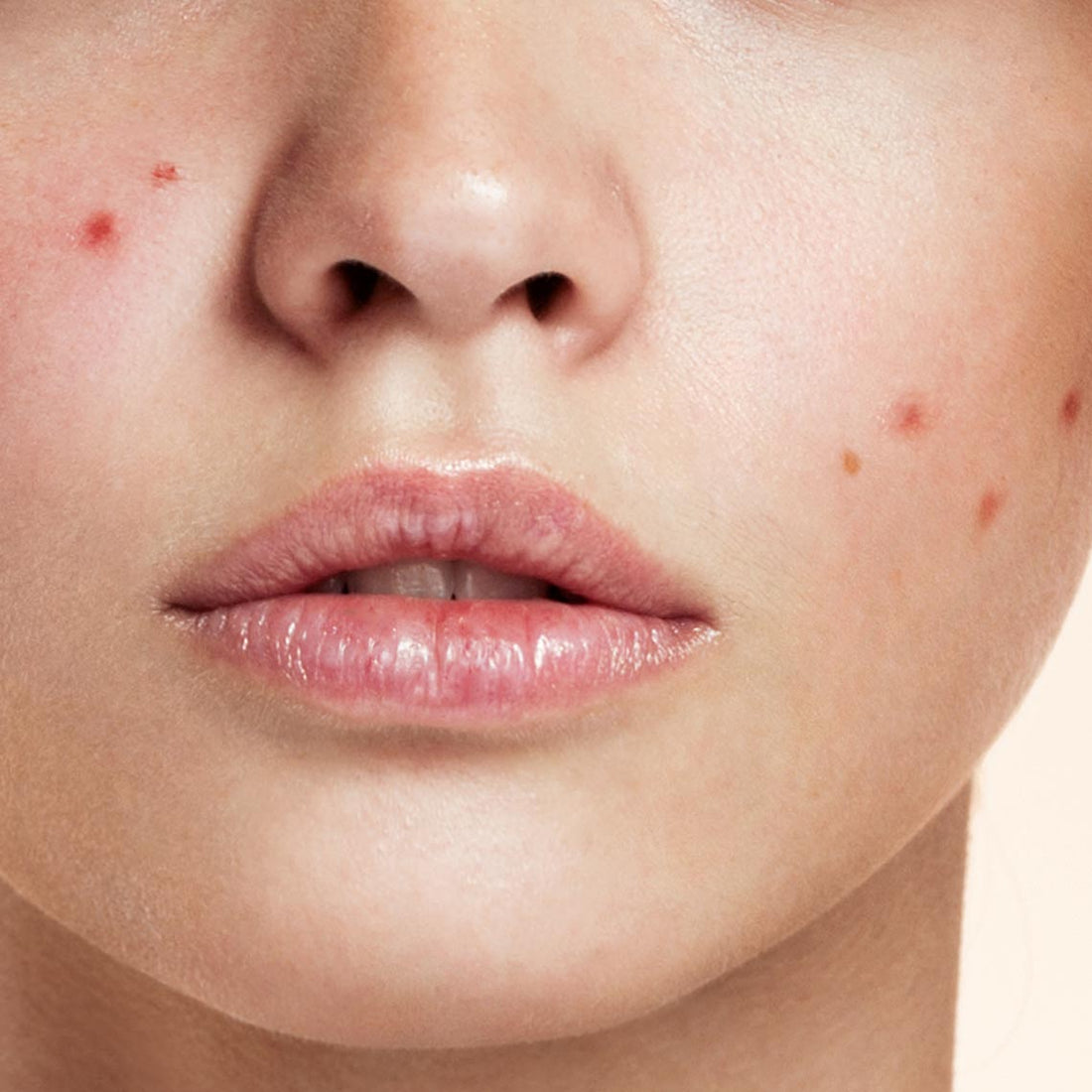 Blemishes: causes and treatment