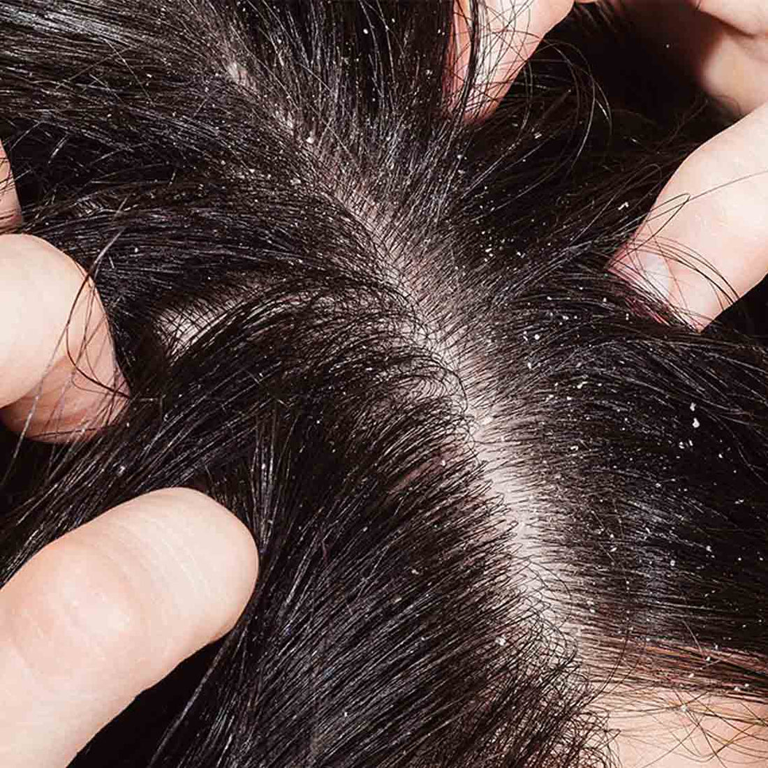 4 Easy Home Remedies Best for Curing Dandruff