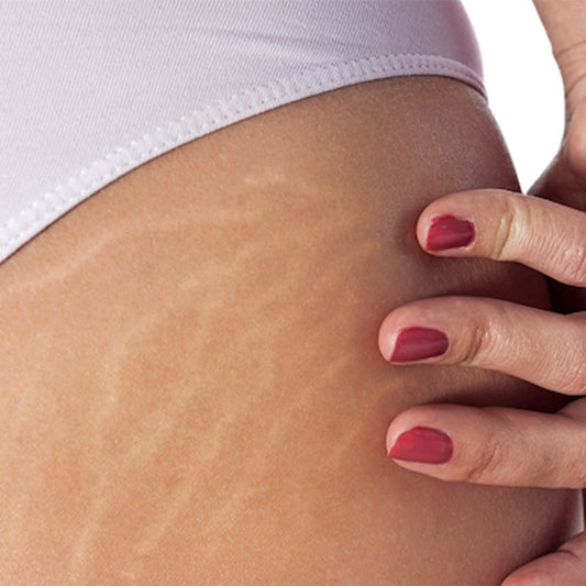 Ways to combat cellulite & stretch marks