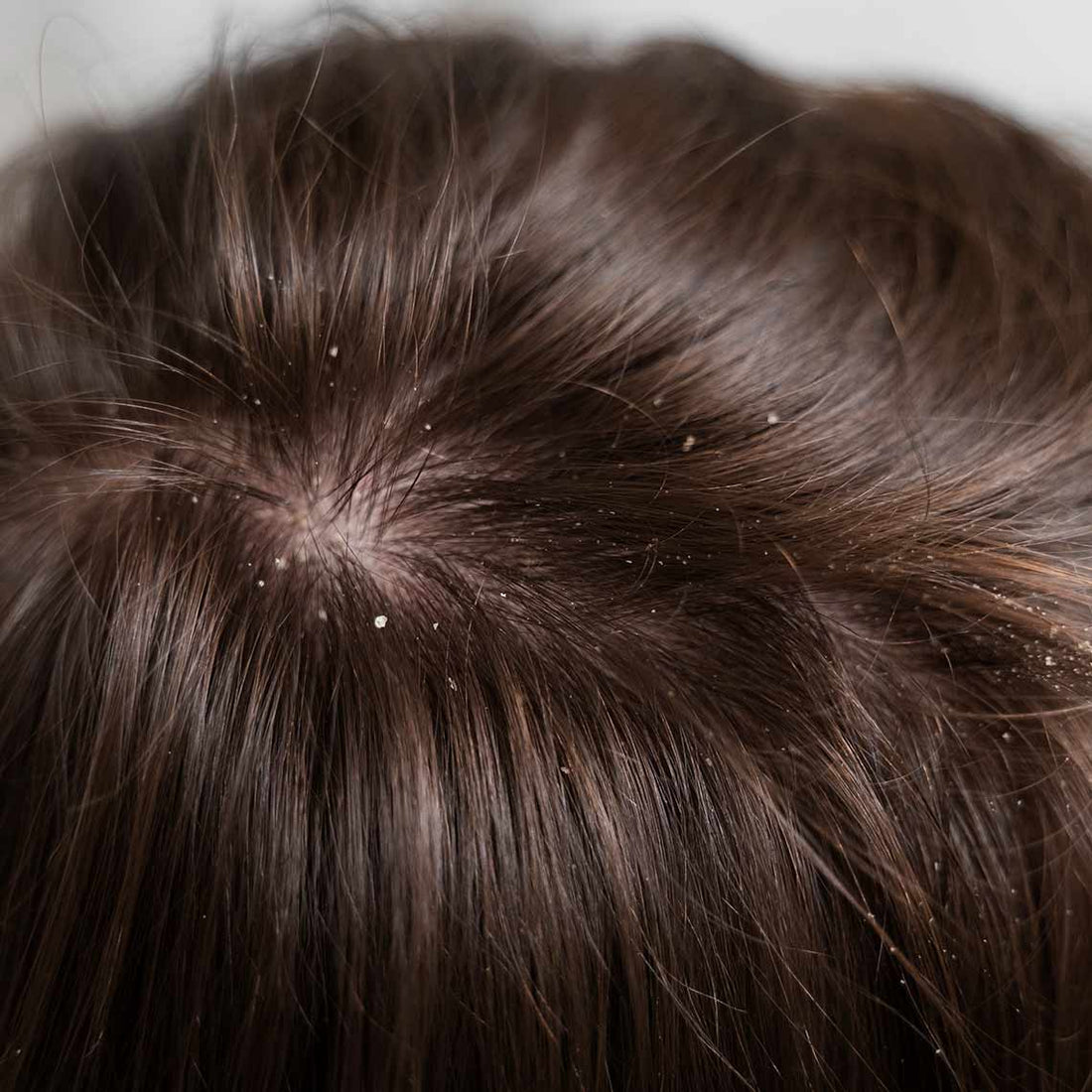 How to Guard Your Scalp From Dandruff Causing Microbes