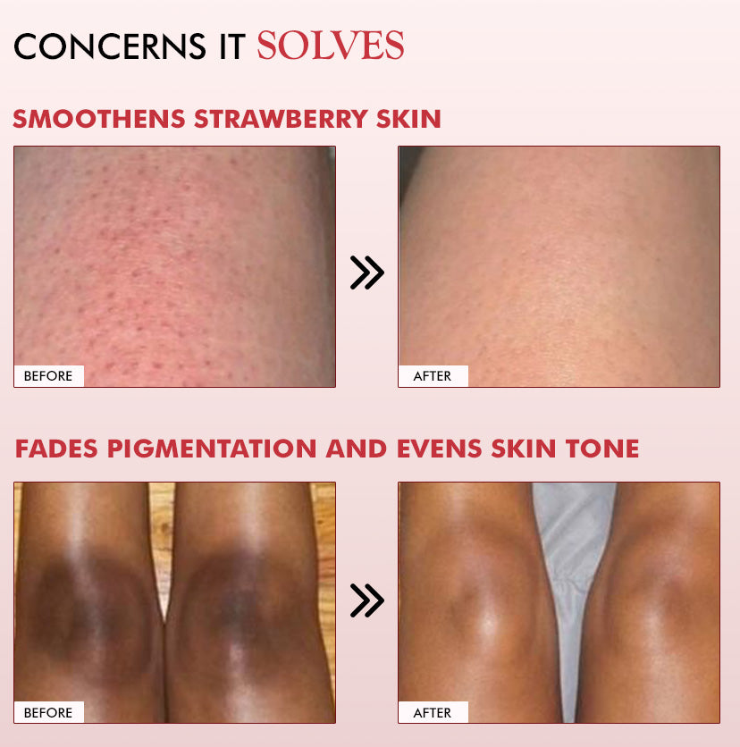 mCaffeine 11% AHA BHA Strawberry Body Lotion 200 ml - concerns panel with before and after shots of strawberry skin and knees