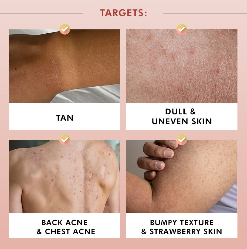 Brighten, De-Tan & Acne-Free Body Wash Combo