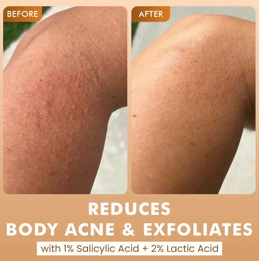 mCaffeine Caramel Crunch Exfoliating Body Wash 300 ml - before and after knee comparison with the salicylic and lactic acid callout