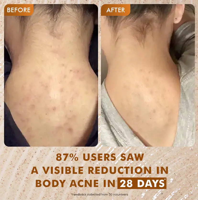 mCaffeine Caramel Crunch Exfoliating Body Wash 300 ml - before and after back comparison with a 28-day consumer study footnote